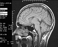 MRI image #2